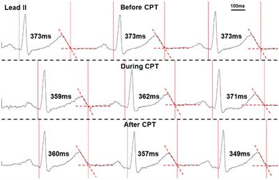 Skin Sympathetic Nerve Activity and the Short-Term QT Interval Variability in Patients With Electrical Storm